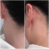before after